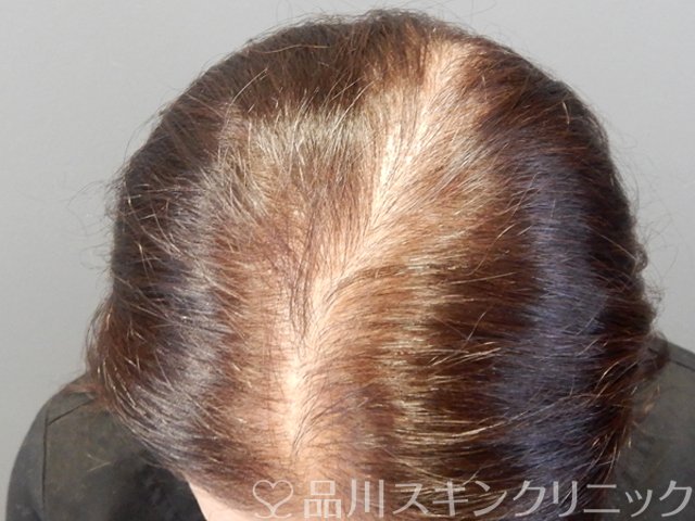 症例NO.69316のBEFORE写真