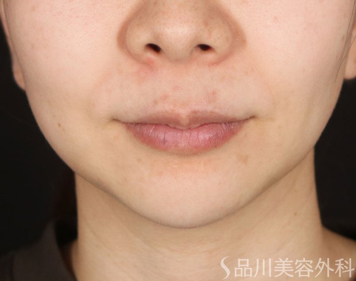 症例NO.73290のBEFORE写真