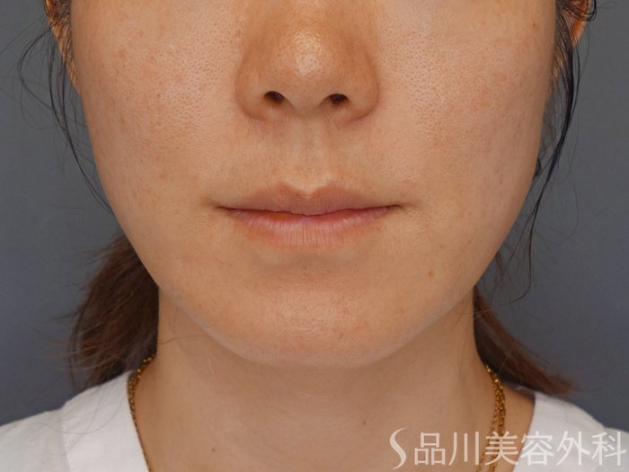 症例NO.72078のBEFORE写真