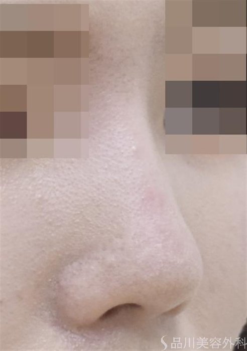 症例NO.52913のAFTER写真