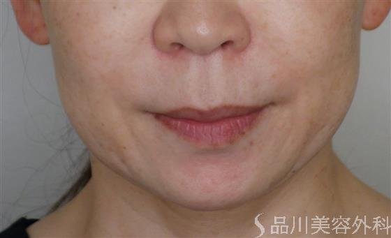 症例NO.51904のBEFORE写真