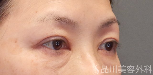 症例NO.74655のAFTER写真