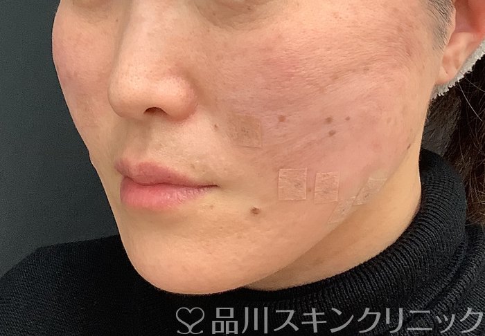 症例NO.69484のAFTER写真