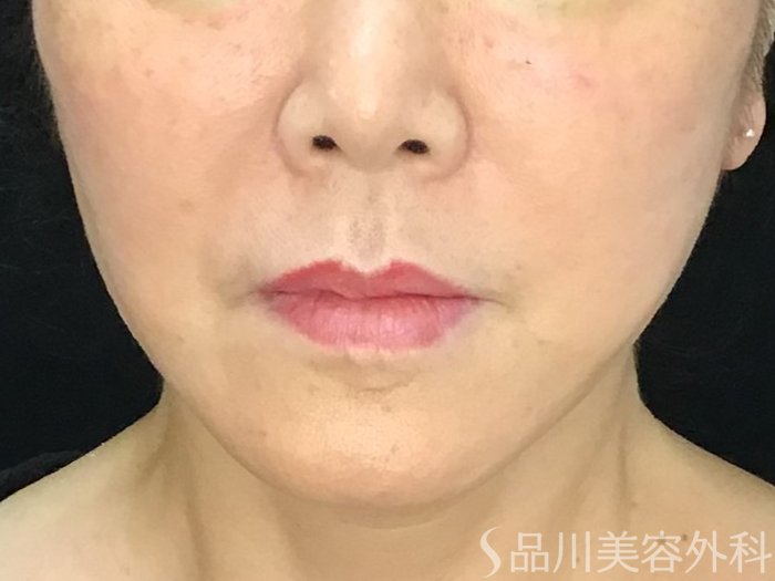 症例NO.71596のAFTER写真