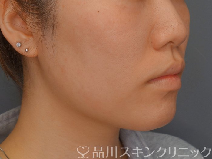 症例NO.74136のBEFORE写真