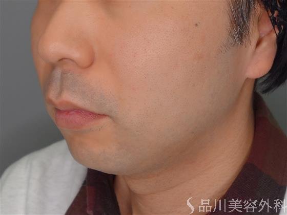 症例NO.53677のBEFORE写真