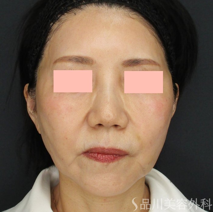 症例NO.73505のAFTER写真