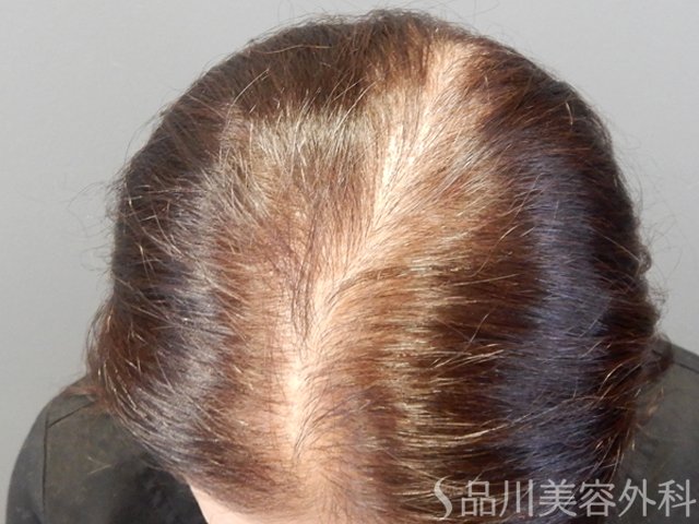症例NO.69316のBEFORE写真