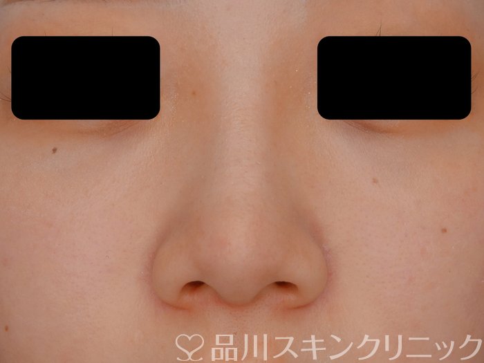 症例NO.70949のBEFORE写真