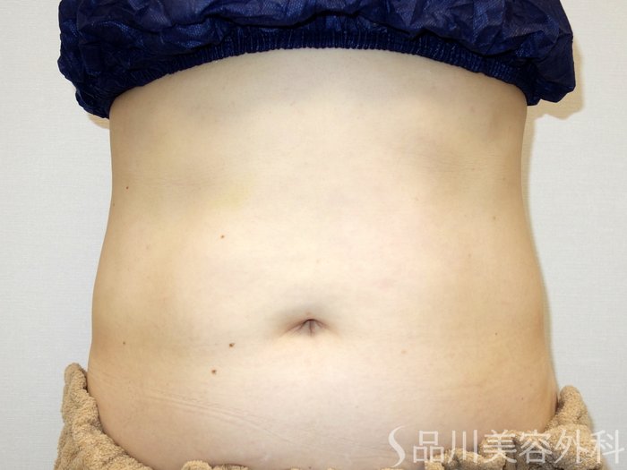症例NO.65557のAFTER写真