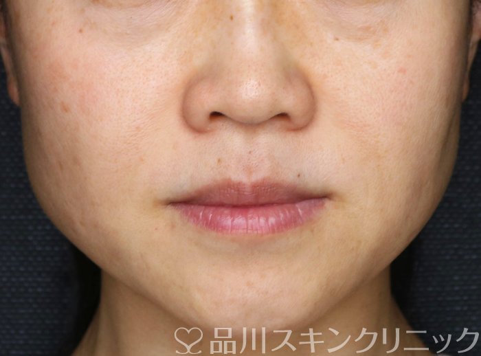 症例NO.64334のBEFORE写真