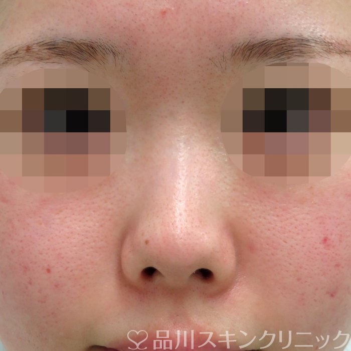 症例NO.71290のBEFORE写真