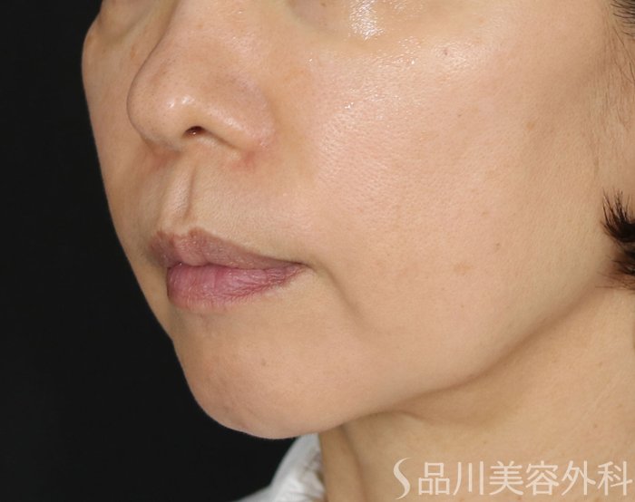 症例NO.71812のBEFORE写真