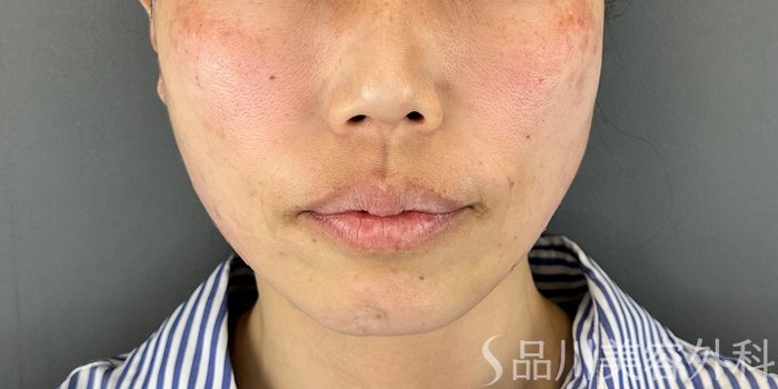 症例NO.70809のAFTER写真