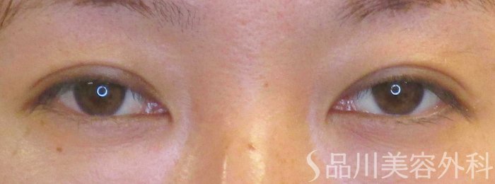 症例NO.69227のAFTER写真
