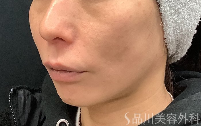 症例NO.69485のAFTER写真