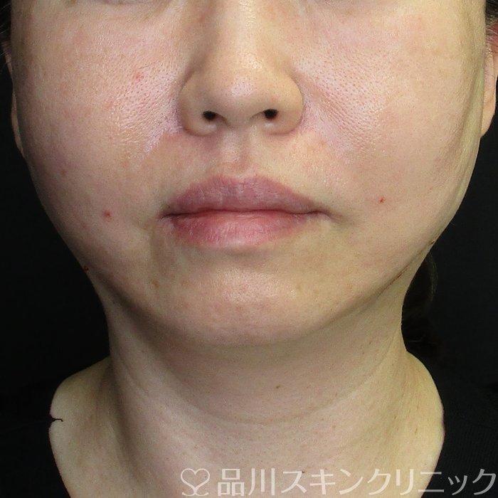 症例NO.62433のAFTER写真