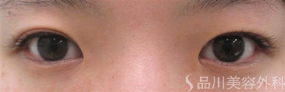 症例NO.22646のBEFORE写真