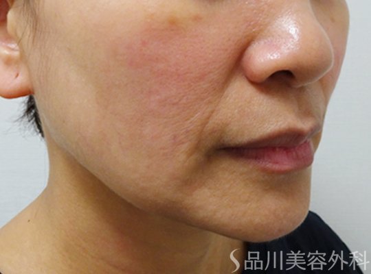 症例NO.73051のBEFORE写真