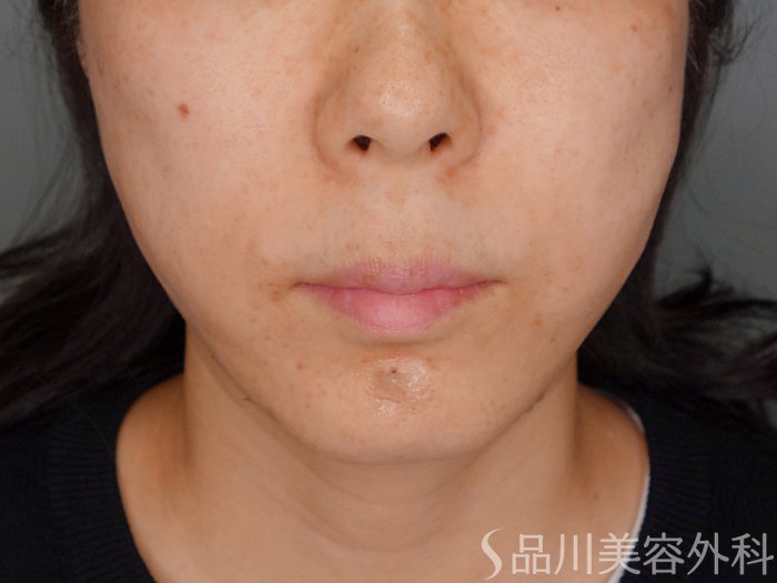 症例NO.70608のAFTER写真