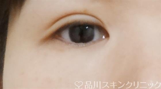 症例NO.37527のAFTER写真