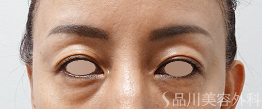 症例NO.64975のBEFORE写真
