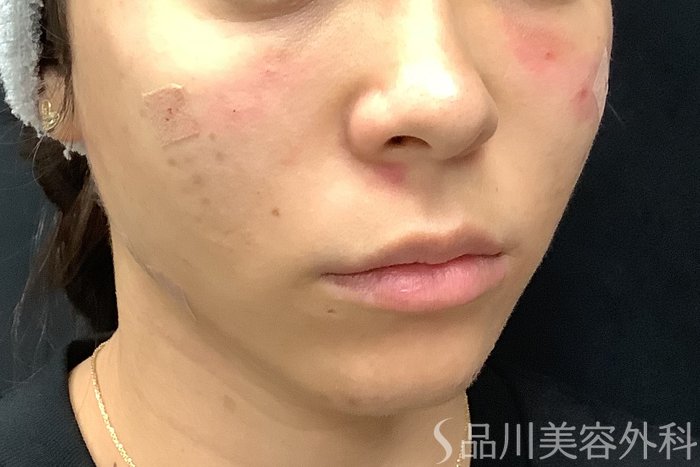 症例NO.67803のAFTER写真