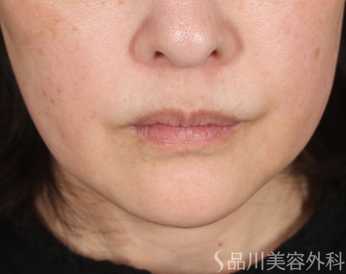 症例NO.73589のBEFORE写真