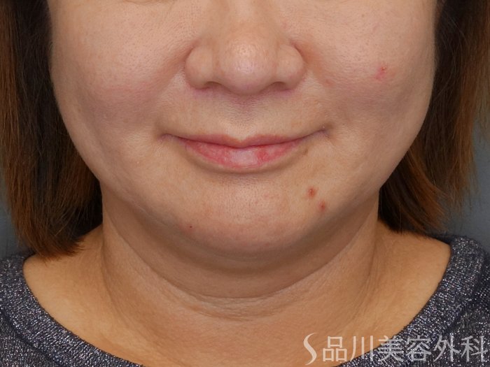 症例NO.72816のBEFORE写真