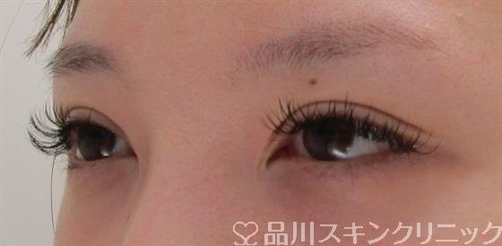 症例NO.42069のAFTER写真