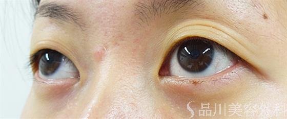 症例NO.29072のBEFORE写真