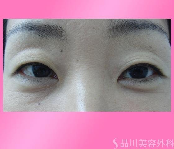 症例NO.4060のBEFORE写真