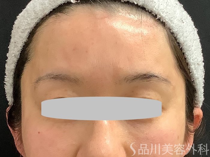 症例NO.67761のAFTER写真