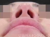 症例NO.73206のBEFORE写真