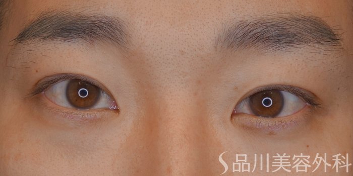 症例NO.74204のAFTER写真