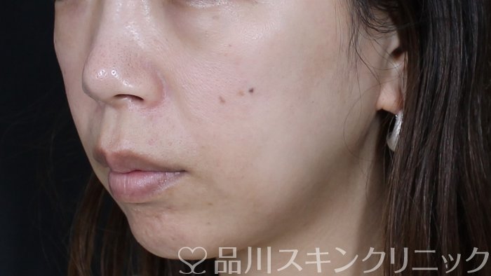 症例NO.71170のBEFORE写真