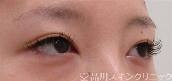 症例NO.42069のBEFORE写真