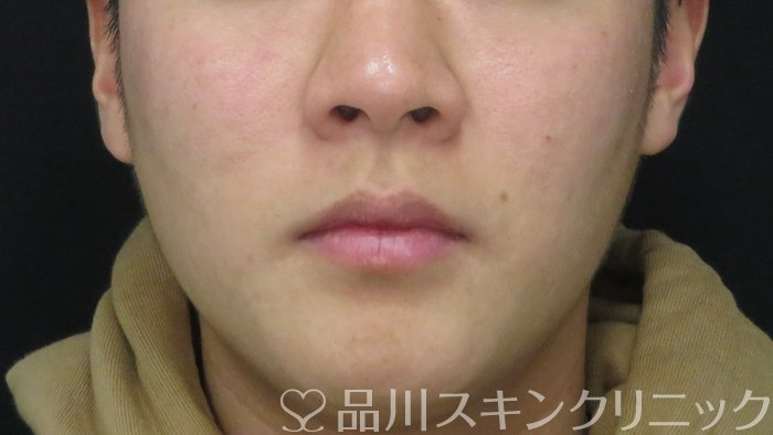 症例NO.70863のBEFORE写真