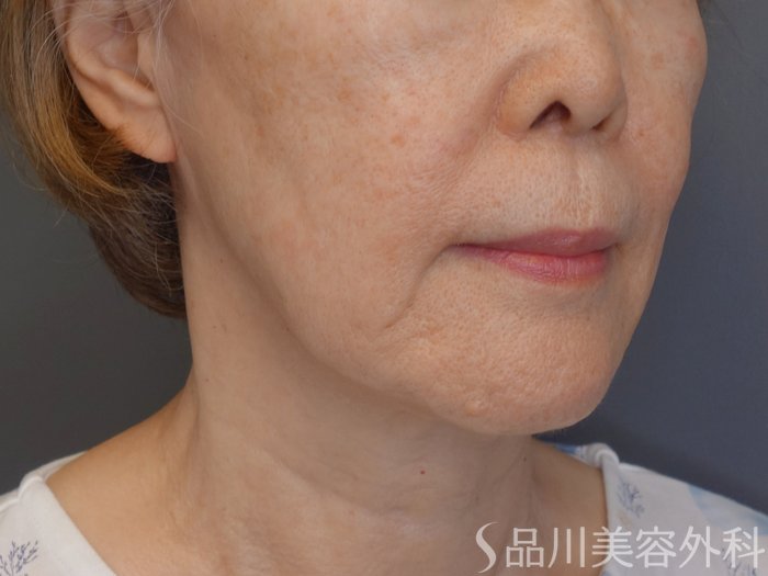 症例NO.71751のBEFORE写真