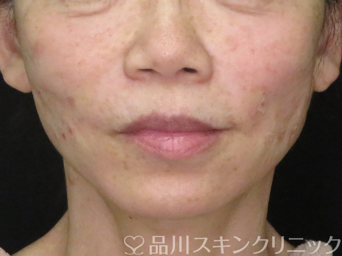 症例NO.70580のAFTER写真