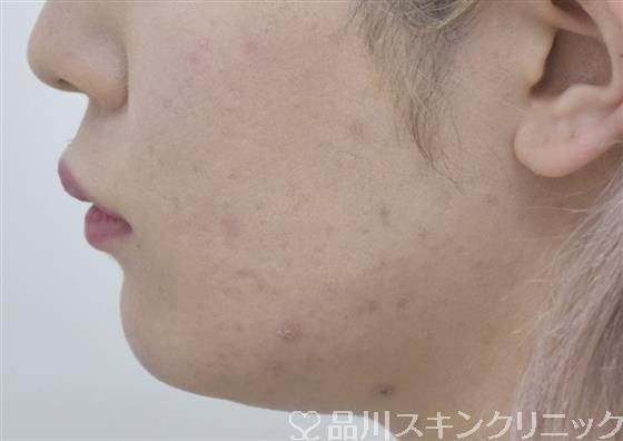 症例NO.53434のBEFORE写真