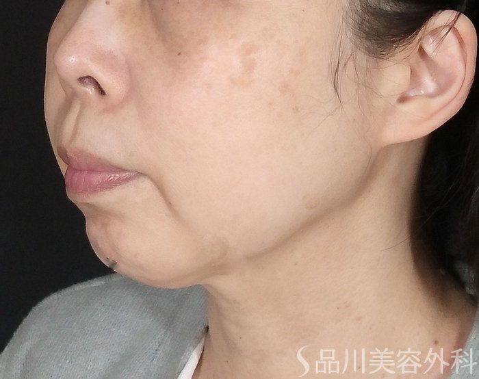 症例NO.64809のBEFORE写真