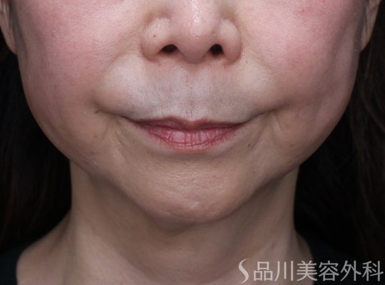 症例NO.72443のAFTER写真