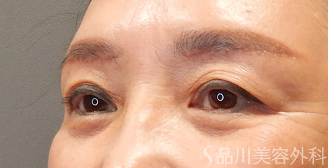 症例NO.73283のAFTER写真