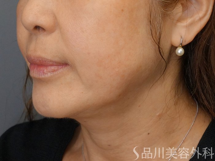 症例NO.70195のBEFORE写真