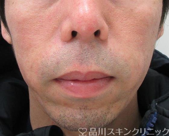 症例NO.33447のAFTER写真
