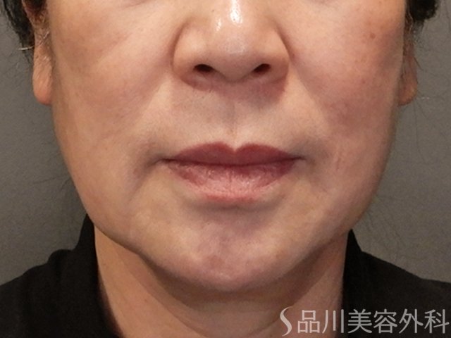 症例NO.73651のBEFORE写真