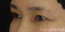 症例NO.74106のAFTER写真