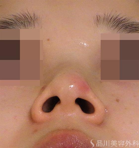 症例NO.40180のBEFORE写真