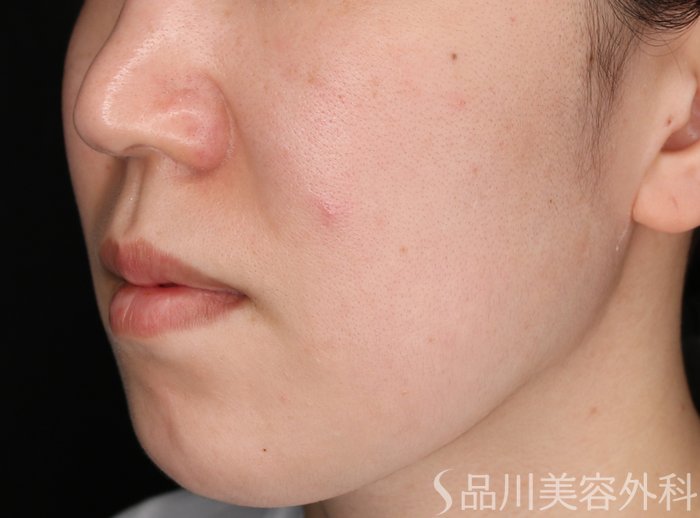 症例NO.70831のBEFORE写真